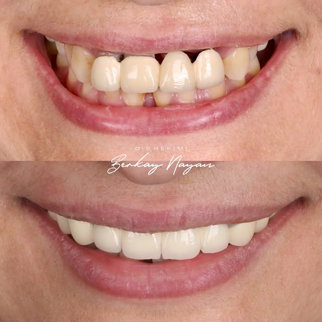 ✔️Uyumunu yitirmiş porselen kronların yenilenmesi. #smilemakeover #dentist #gülüştasarımı #zirconia #afyonkarahisar